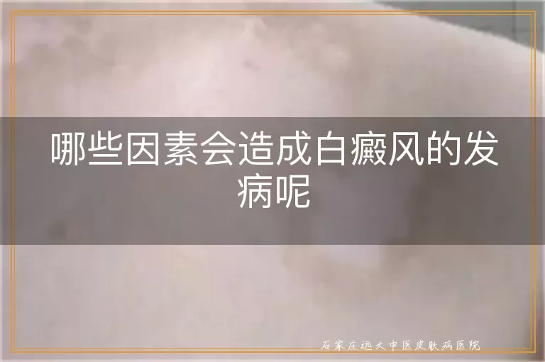 哪些因素会造成白癜风的发病呢