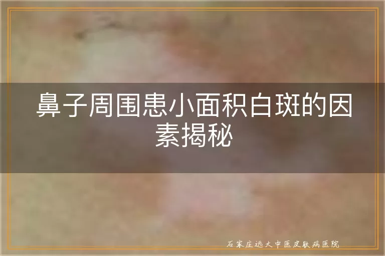 鼻子周围患小面积白斑的因素揭秘