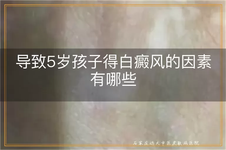 导致5岁孩子得白癜风的因素有哪些