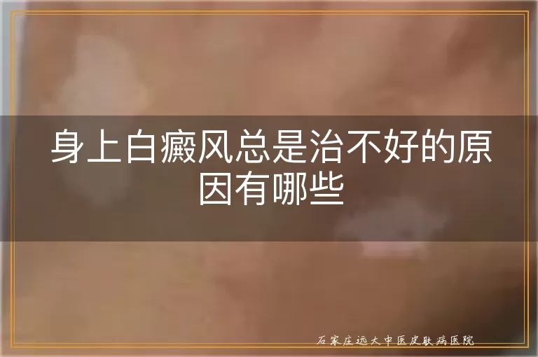 身上白癜风总是治不好的原因有哪些