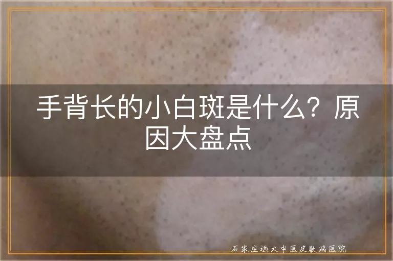 手背长的小白斑是什么？原因大盘点