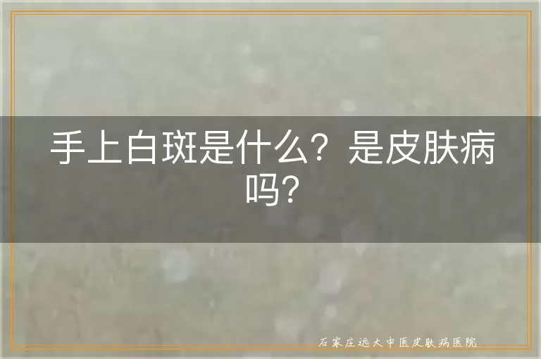 手上白斑是什么？是皮肤病吗？