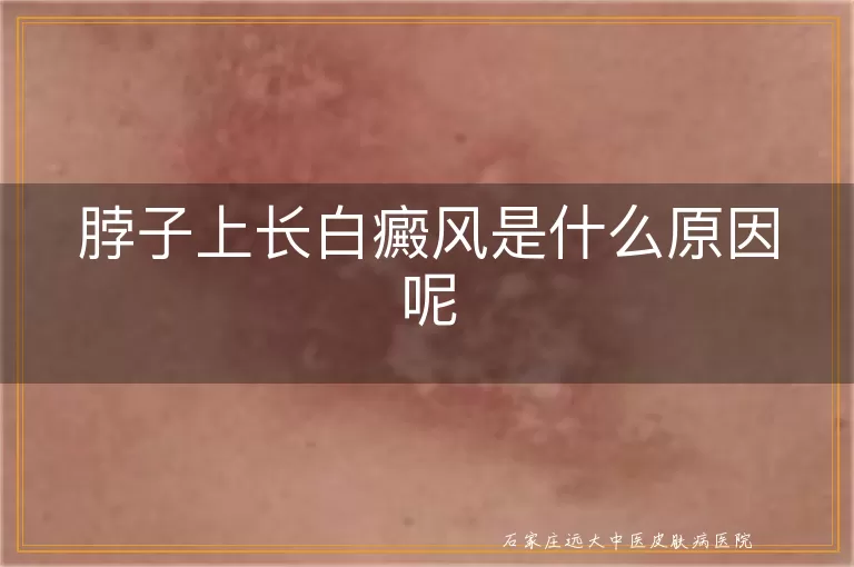 脖子上长白癜风是什么原因呢