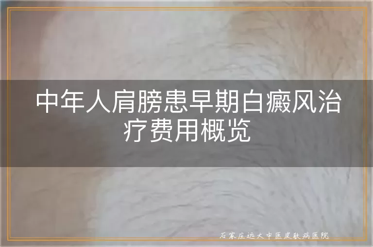 中年人肩膀患早期白癜风治疗费用概览