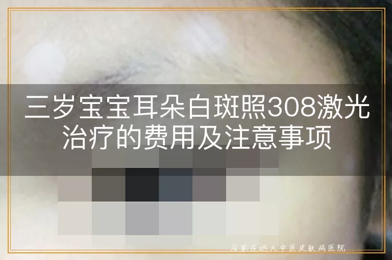 三岁宝宝耳朵白斑照308激光治疗的费用及注意事项