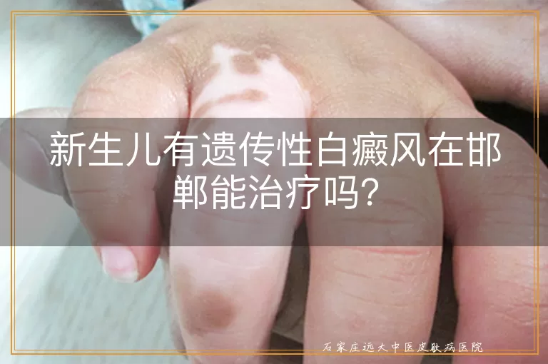 新生儿有遗传性白癜风在邯郸能治疗吗？