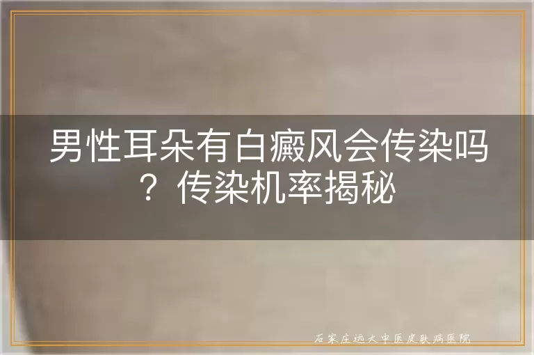 男性耳朵有白癜风会传染吗？传染机率揭秘