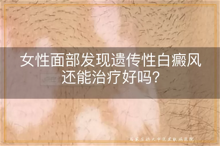 女性面部发现遗传性白癜风还能治疗好吗？