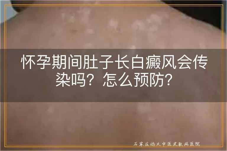 怀孕期间肚子长白癜风会传染吗？怎么预防？