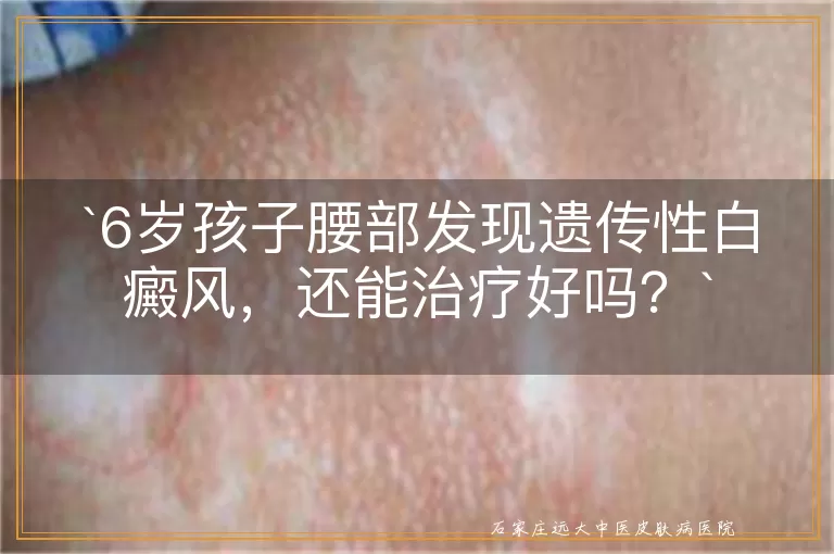 6岁孩子腰部发现遗传性白癜风，还能治疗好吗？