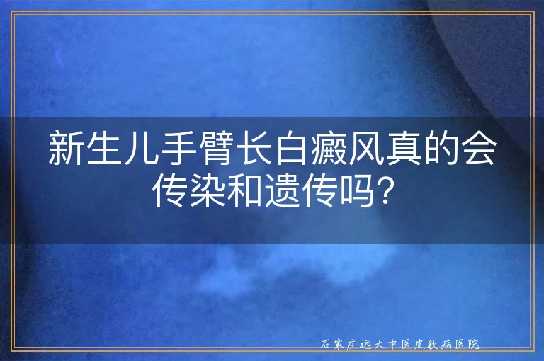 新生儿手臂长白癜风真的会传染和遗传吗？