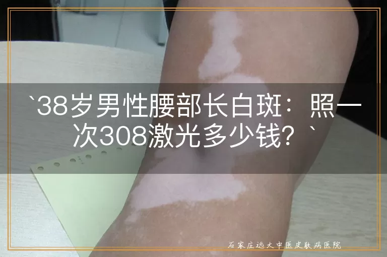 38岁男性腰部长白斑：照一次308激光多少钱？