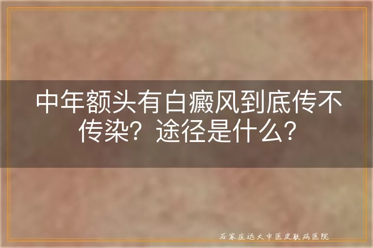 中年额头有白癜风到底传不传染？途径是什么？