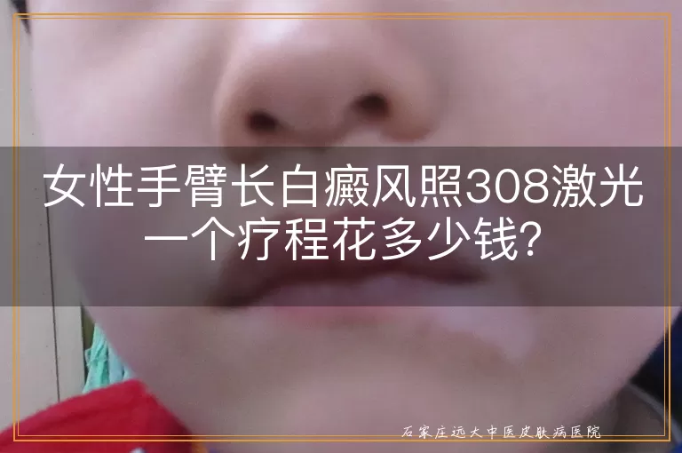 女性手臂长白癜风照308激光一个疗程花多少钱？