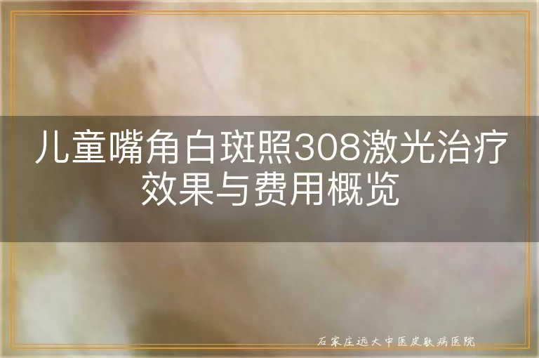 儿童嘴角白斑照308激光治疗效果与费用概览