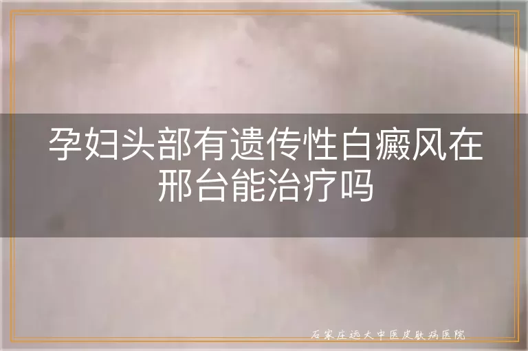 孕妇头部有遗传性白癜风在石家庄能治疗吗