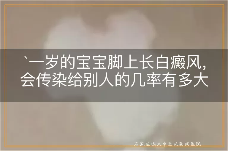 一岁的宝宝脚上长白癜风，会传染给别人的几率有多大？