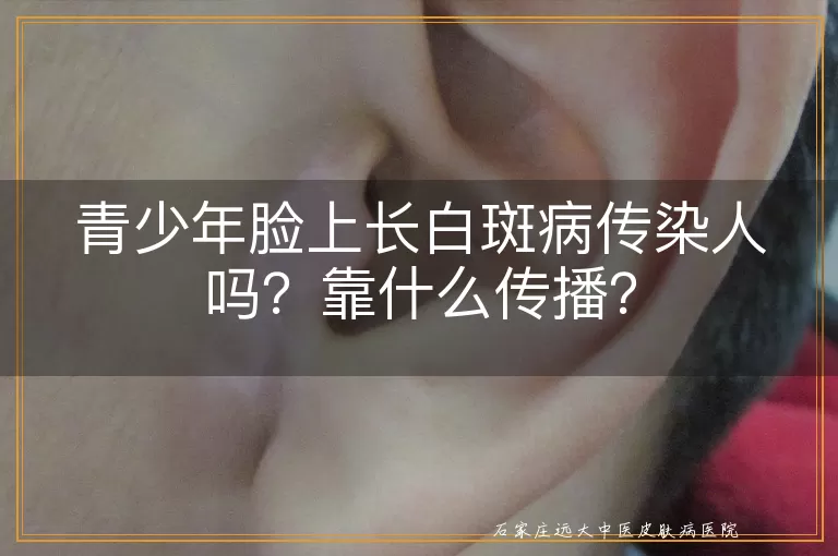 青少年脸上长白斑病传染人吗？靠什么传播？