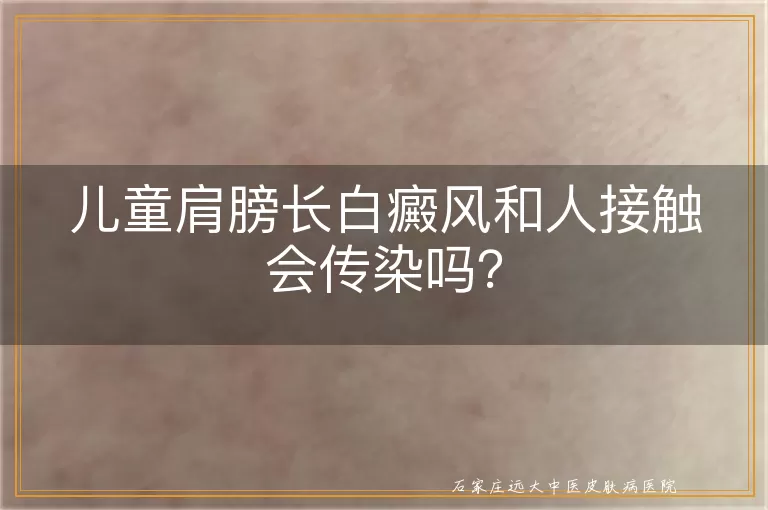 儿童肩膀长白癜风和人接触会传染吗？