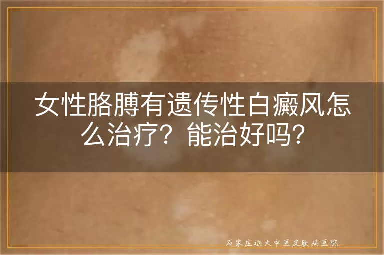 女性胳膊有遗传性白癜风怎么治疗？能治好吗？