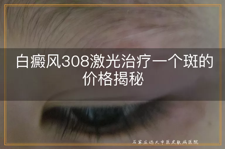 白癜风308激光治疗一个斑的价格揭秘