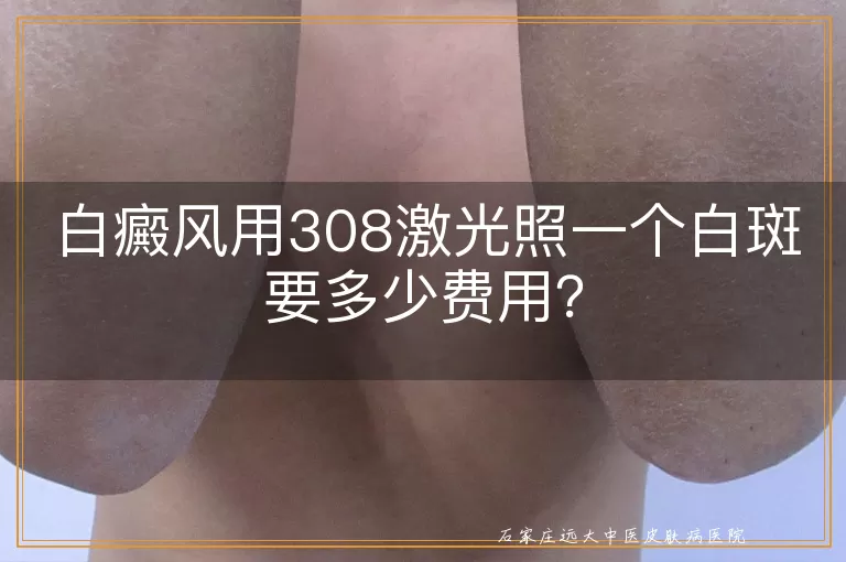 白癜风用308激光照一个白斑要多少费用？