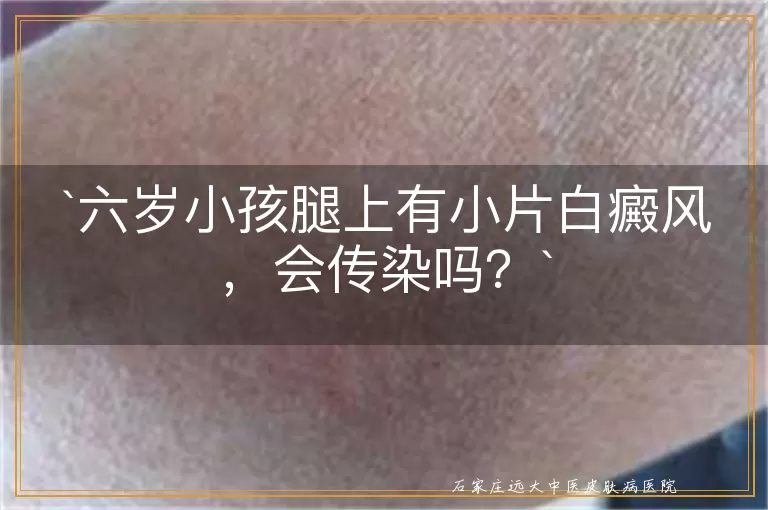 六岁小孩腿上有小片白癜风，会传染吗？