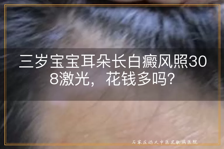 三岁宝宝耳朵长白癜风照308激光，花钱多吗？