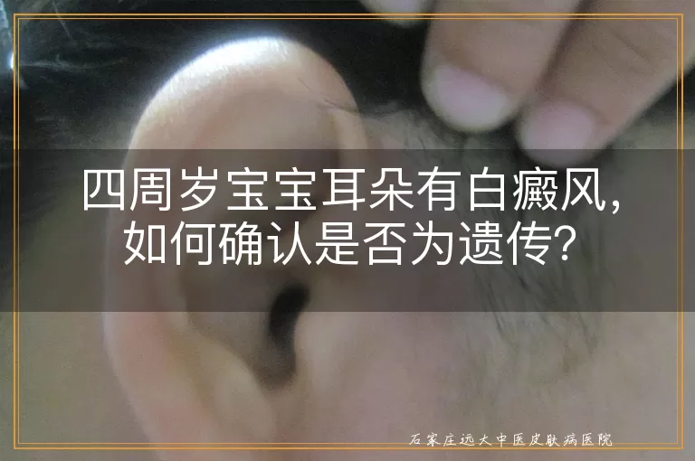 四周岁宝宝耳朵有白癜风，如何确认是否为遗传？