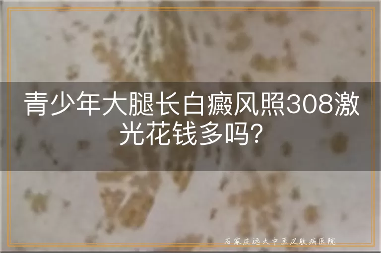 青少年大腿长白癜风照308激光花钱多吗？