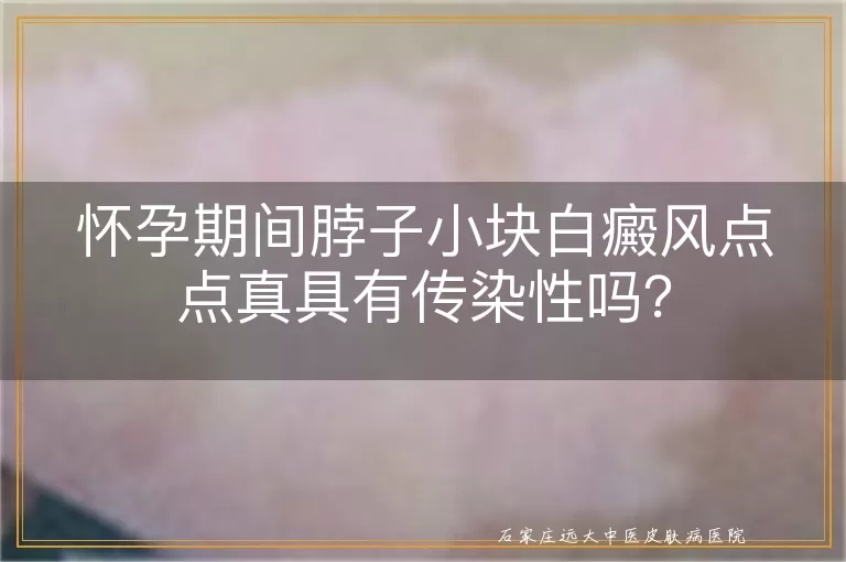 怀孕期间脖子小块白癜风点点真具有传染性吗？