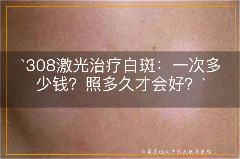 308激光治疗白斑：一次多少钱？照多久才会好？