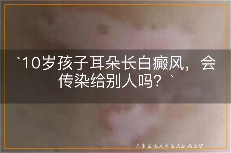 10岁孩子耳朵长白癜风，会传染给别人吗？