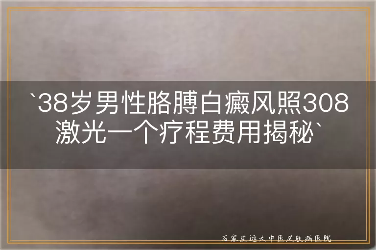 38岁男性胳膊白癜风照308激光一个疗程费用揭秘