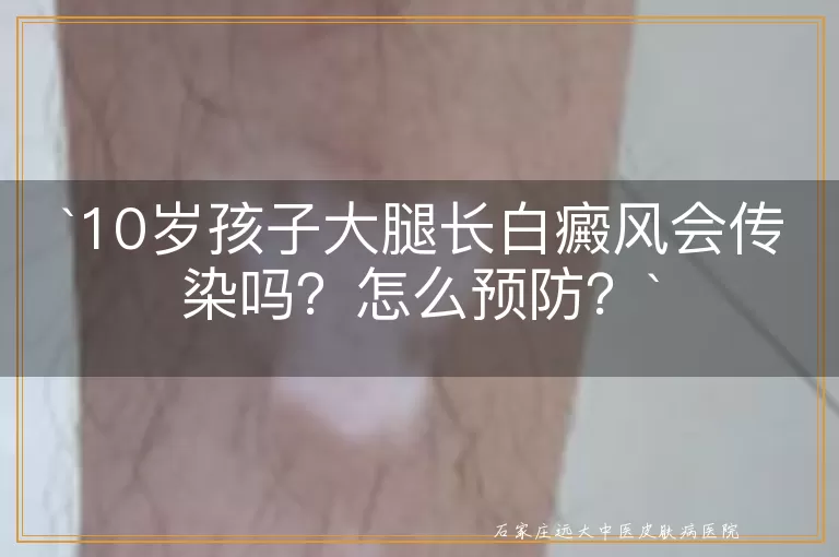 10岁孩子大腿长白癜风会传染吗？怎么预防？