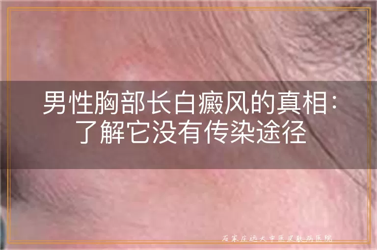 男性胸部长白癜风的真相：了解它没有传染途径