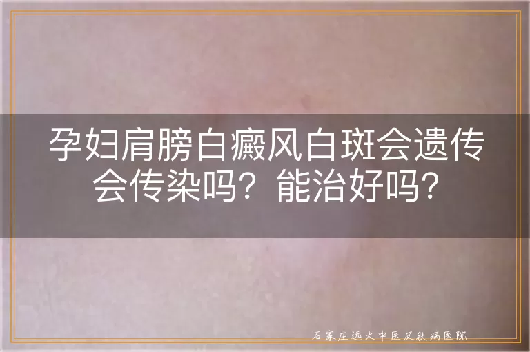 孕妇肩膀白癜风白斑会遗传会传染吗？能治好吗？