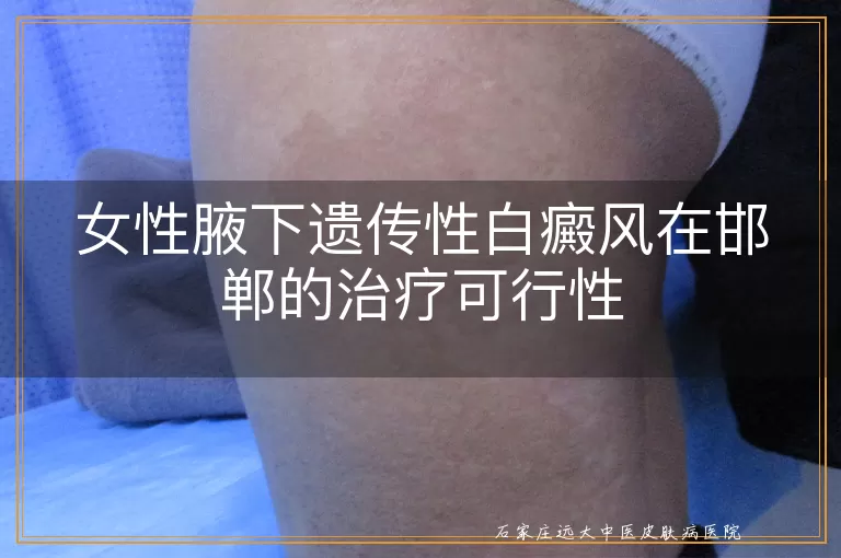 女性腋下遗传性白癜风在邯郸的治疗可行性