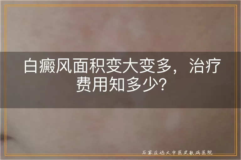 白癜风面积变大变多，治疗费用知多少？