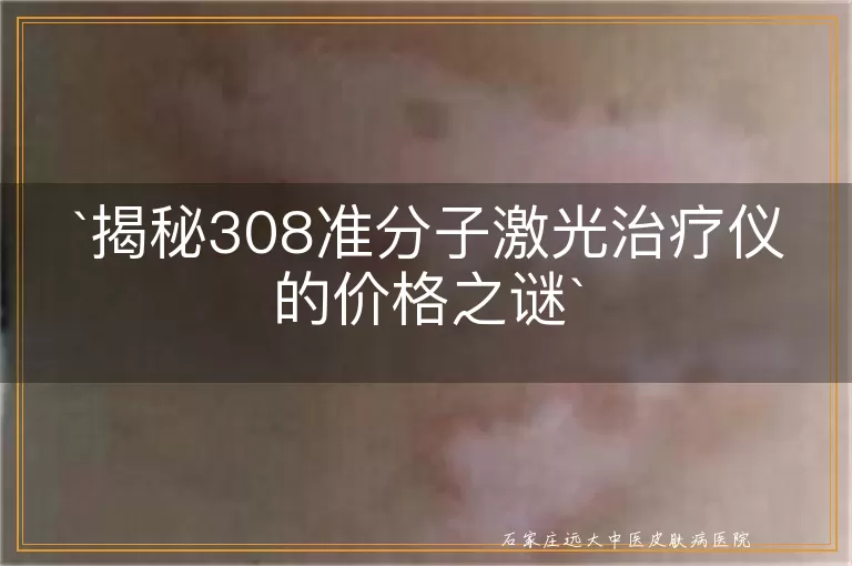 揭秘308准分子激光治疗仪的价格之谜