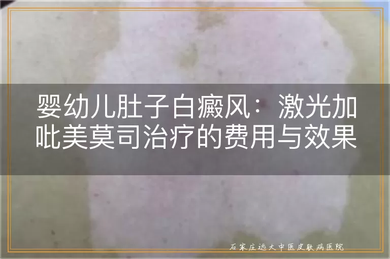 婴幼儿肚子白癜风：激光加吡美莫司治疗的费用与效果探索