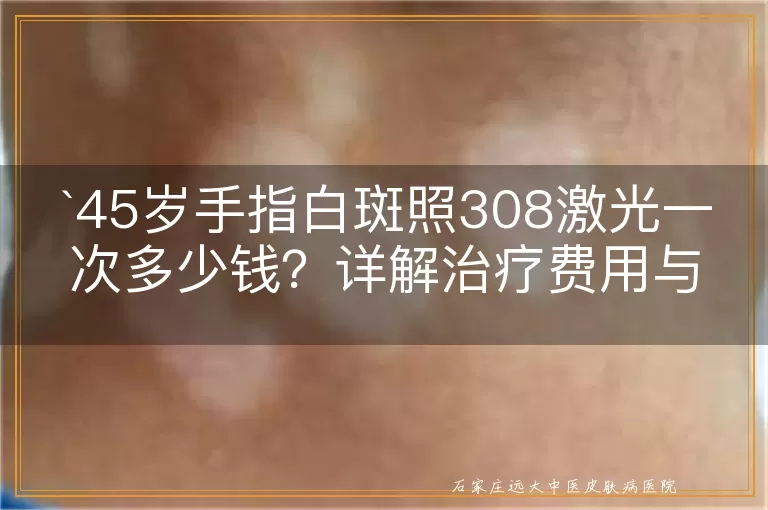 45岁手指白斑照308激光一次多少钱？详解治疗费用与效果