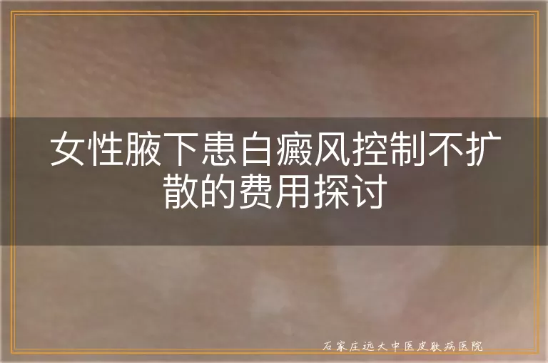 女性腋下患白癜风控制不扩散的费用探讨