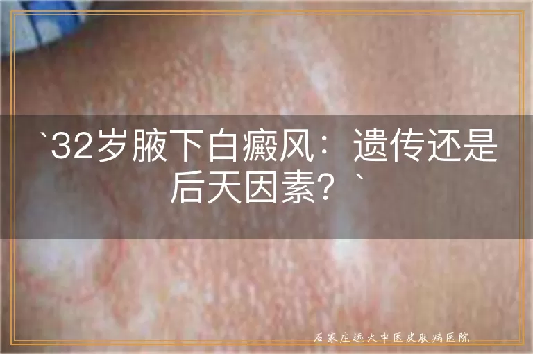 32岁腋下白癜风：遗传还是后天因素？