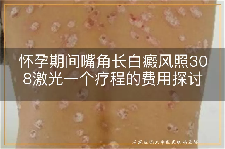 怀孕期间嘴角长白癜风照308激光一个疗程的费用探讨