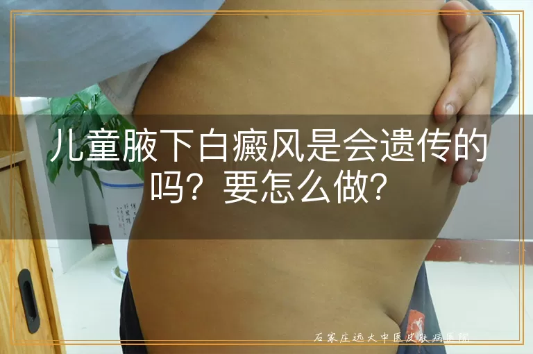 儿童腋下白癜风是会遗传的吗？要怎么做？