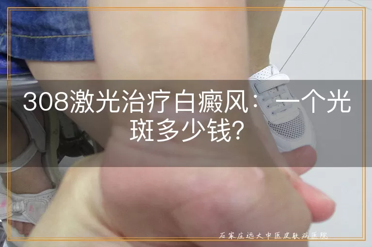 308激光治疗白癜风：一个光斑多少钱？