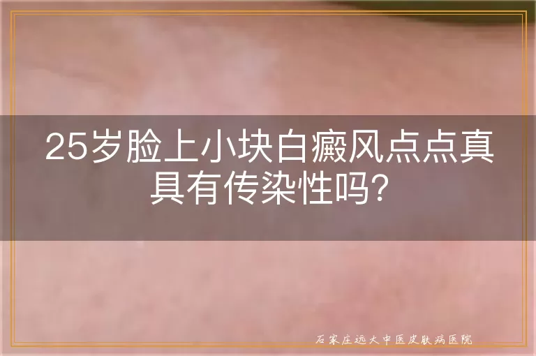 25岁脸上小块白癜风点点真具有传染性吗？