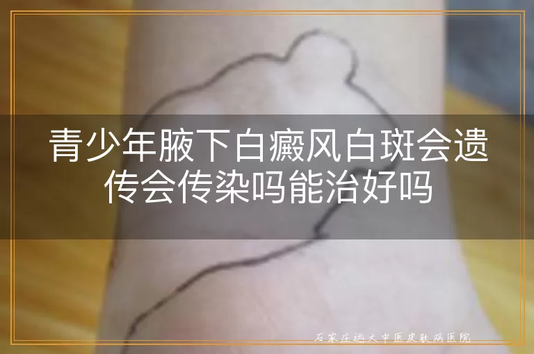 青少年腋下白癜风白斑会遗传会传染吗能治好吗