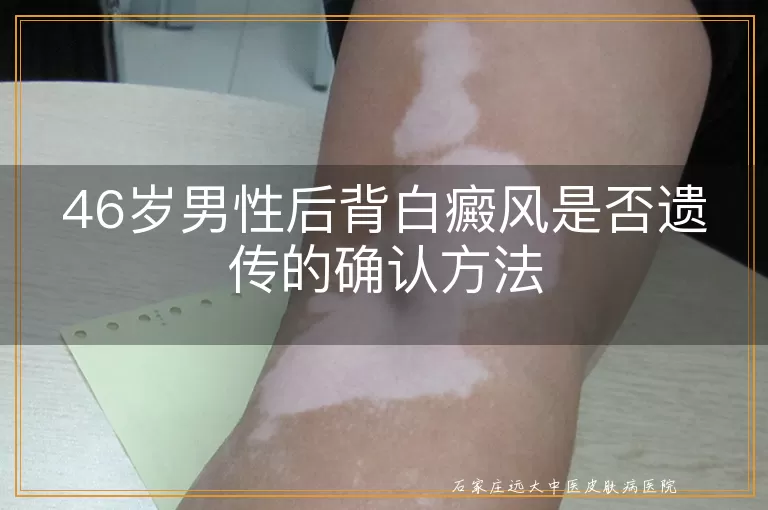 46岁男性后背白癜风是否遗传的确认方法